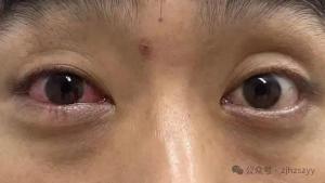 男子遇五步蛇想抓来玩被喷一脸毒男子遭遇五步蛇，好奇心驱使尝试抓捕却遭喷毒